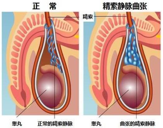 精索静脉曲张